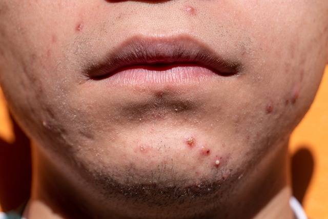 traitement acné soins peau